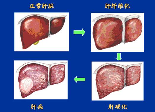 请问肝纤维化是什么病？一篇文章带你深入了解